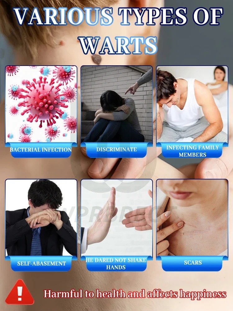 Best wart removal product Australia