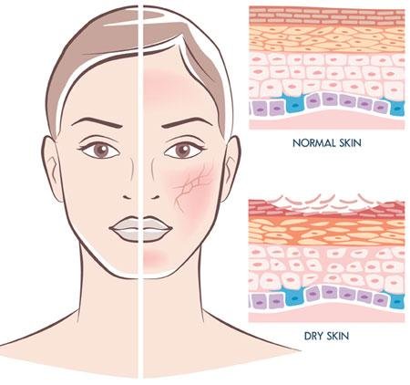 Dry skin symptoms