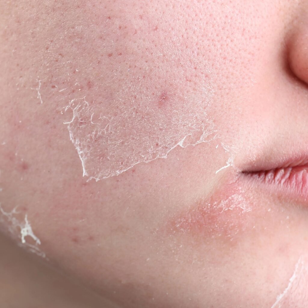 Dry skin symptoms